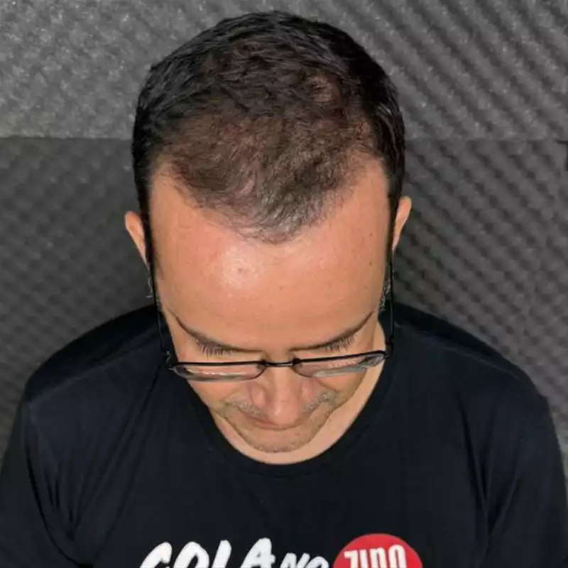 Transplante Capilar na Clínica Cappelli - 3 meses pós transplante do Seu Zine